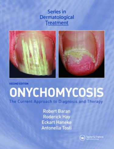 Onychomycosis: The Current Approach to Diagnosis and Therapy (2nd edition)