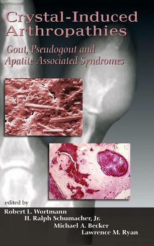 Crystal-Induced Arthropathies: Gout, Pseudogout and Apatite-Associated Syndromes