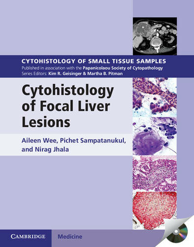 Cytohistology of Focal Liver Lesions: (Cytohistology of Small Tissue Samples)