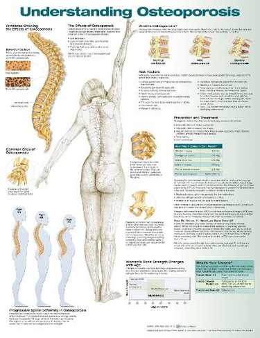 Understanding Osteoporosis Anatomical Chart: (3rd edition)